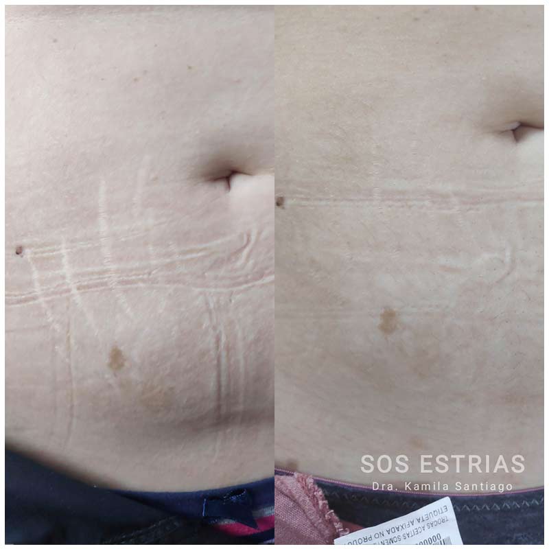 Toxina botulínica - Botox
