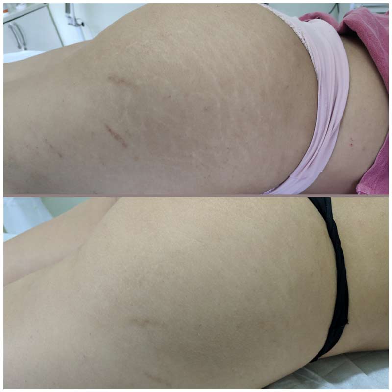 Toxina botulínica - Botox