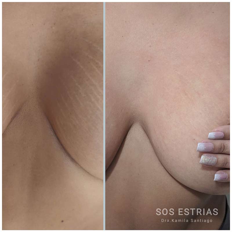 Toxina botulínica - Botox