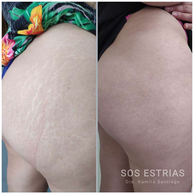 Toxina botulínica - Botox