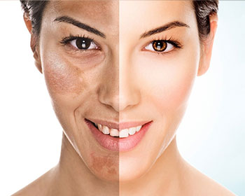Tratamento do melasma - melasma Control